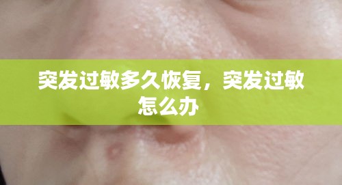 突发过敏多久恢复，突发过敏怎么办 